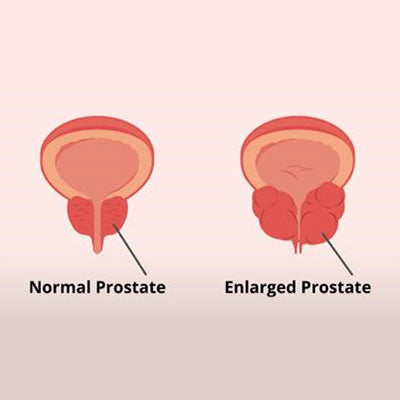Prostate Support