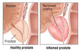 Prostate Support